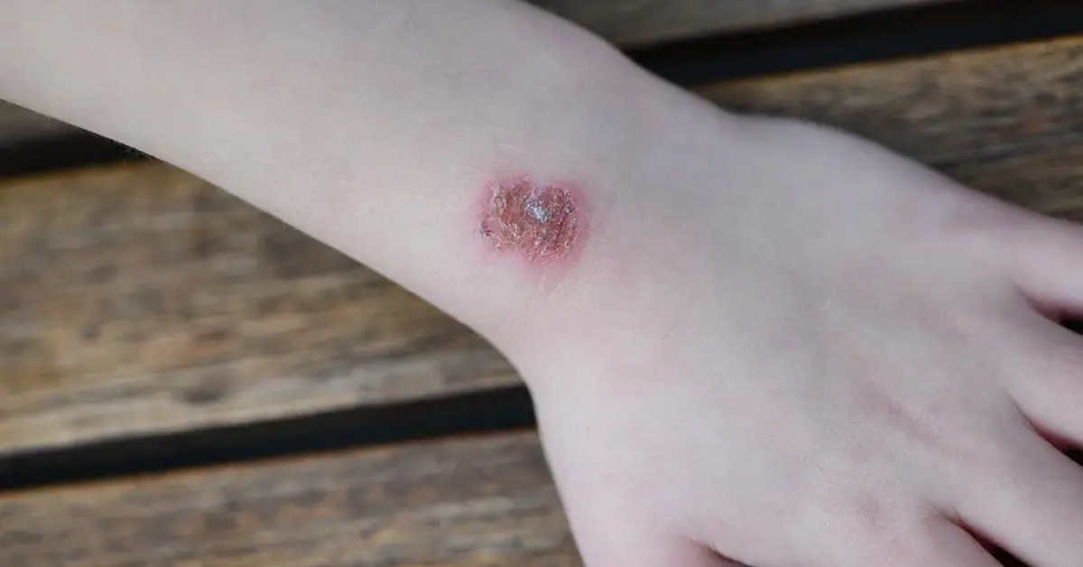 Anh em Trader Việt Nam chú ý: cảnh báo cường độ tia cực tím đang ở mức cao, có thể gây ung thư da